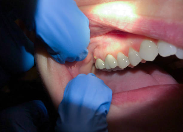 Best Emergency Dentist for Knocked-Out Tooth in Lowellville, OH